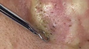 ACNE CLEANING RELAX - KINISH TV  #54