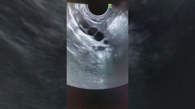 На УЗИ 4 день стимуляции суперовуляции.