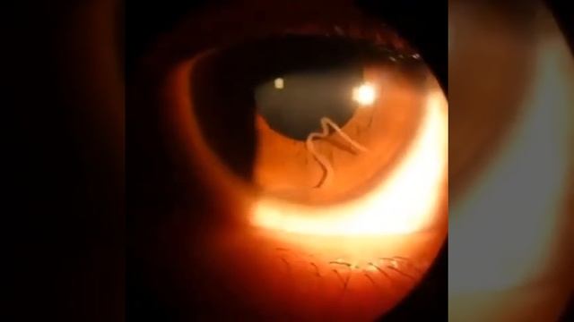 ✔Loa loa infestation called filariases. It is popularly known as "African eye worm" смотреть онлайн