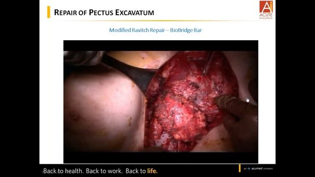 Acute Innovations: Open Pectus Repair protocol and case reviews featuring, Daniel L Miller, MD смотреть онлайн