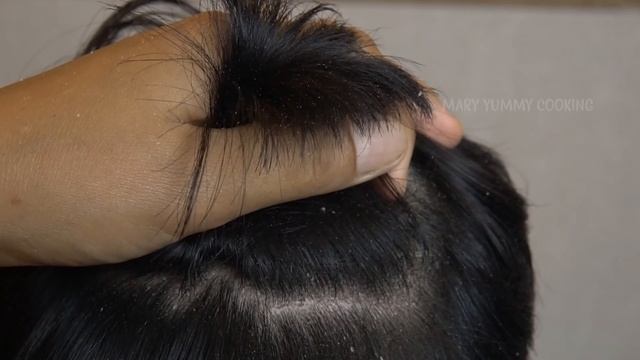 Dandruff Removal Big Flakes On Front Side!!! Dandruff Scratching Satisfying #312 смотреть онлайн