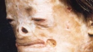 10 САМЫХ СТРАШНЫХ БОЛЕЗНЕЙ!!!ЛЮДЯМ СО СЛАБОЙ ПСИХИКОЙ НЕ РЕКОМЕНДУЕТСЯ!