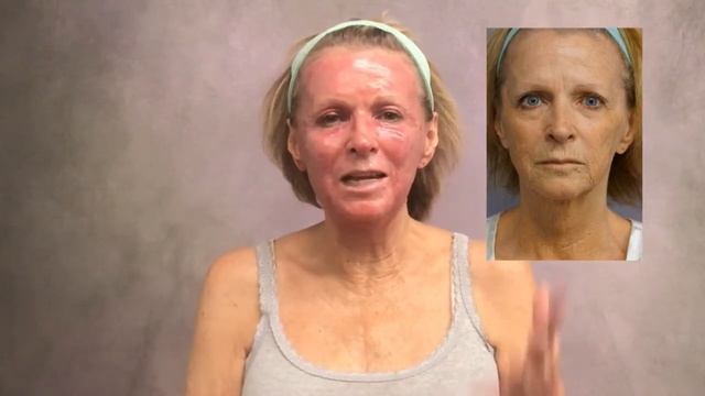 Dr. Lin's J-Plasma SmoothLyft Procedure: Day 9 смотреть онлайн