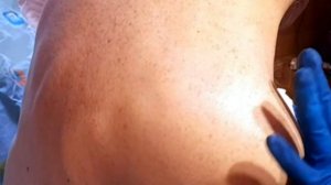 Плазма лифтинг плечевого сустава. Реабилитация. Медицина. Восстановление после травмы.