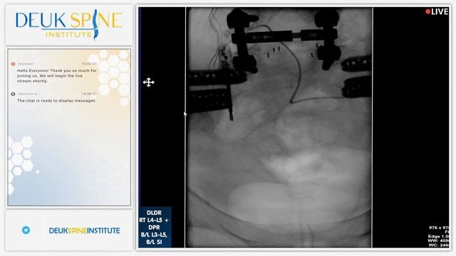 Watch Live Back Treatment! Deuk Plasma Rhizotomy (DPR)- Sacroiliac Joint - (B/L) SI смотреть онлайн