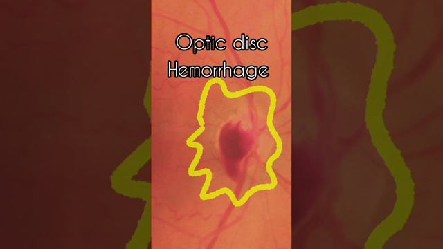 Optic Disc Hemorrhage Or Splinter Hemorrhage #optometrists #glaucomaawareness #ophthalmology