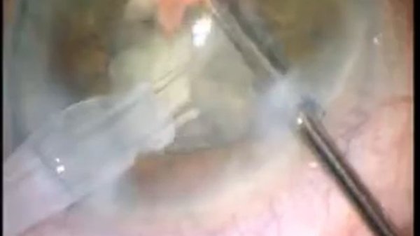 Лазерная Экстракция Катаракты