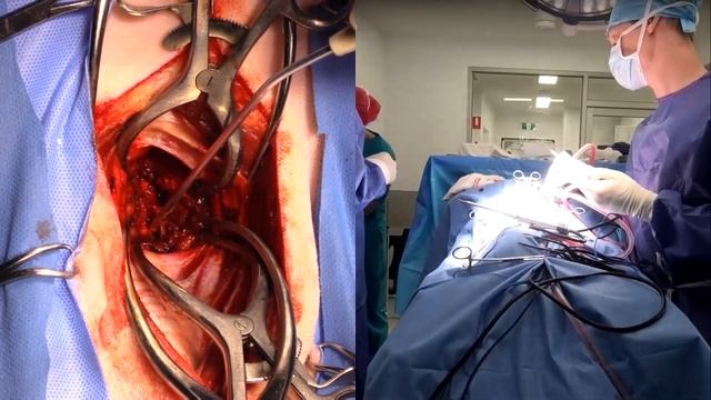 Live stream cervical disc rupture ventral slot in a dog