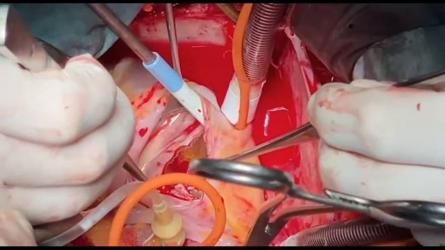 Миксома левого предсердия