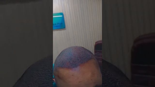 Hair Transplant #hair #realhairtransplant #dhihairtransplant #fuehairtransplant #hairstyle #song