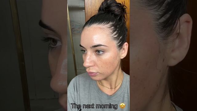 At home Microneedling results after 1 session #microneedling #athomemicroneedling #acnescars смотреть онлайн