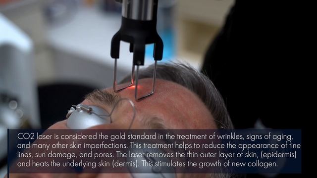 Ultimate Trio: RF Microneedling, CO2 Laser & PRP (Platelet Rich Plasma) | West End Plastic Surgery смотреть онлайн