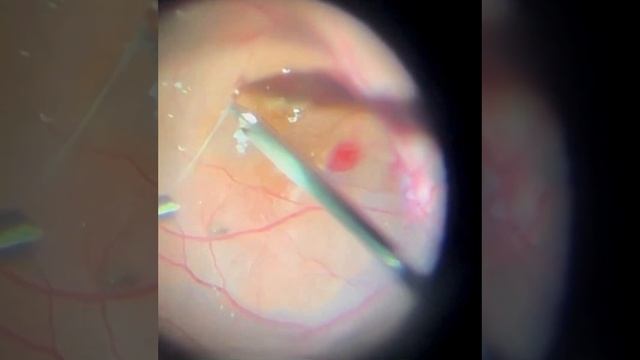 ILM Peeling+ PRP.  Мембранопилинг+ PRP