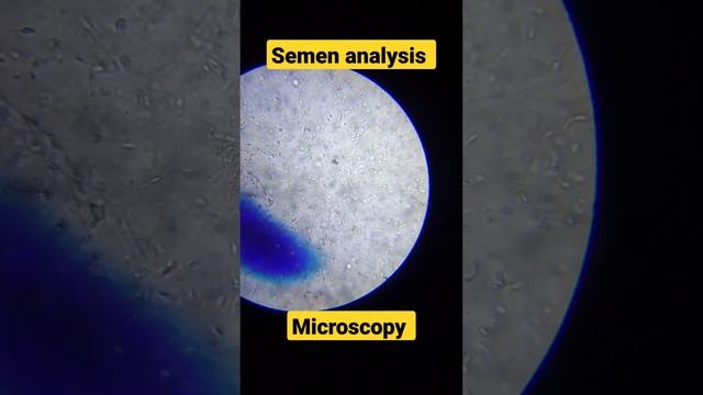 Semen Analysis With Microscope 🔬 | #gynecologist#semenanalysis#spermcount @sachinchauhan00012 смотреть онлайн