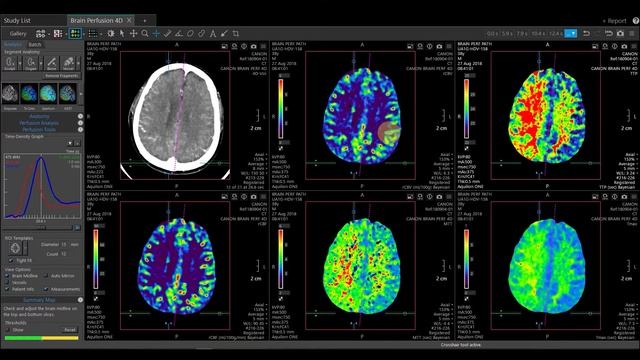 Vitrea Demonstrations  |  4D Brain Perfusion