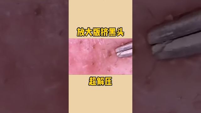 Satisfying Acne, Blackhead, Pimple, Cyst Relaxing 2021.