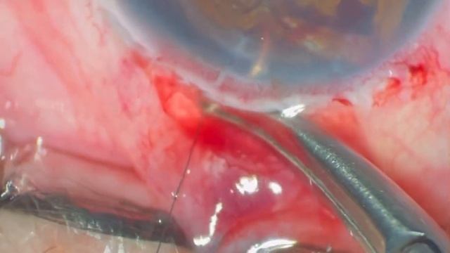 Elimination of post-traumatic iridodialysis. Устранение обширного посттравматического иридодиализа смотреть онлайн