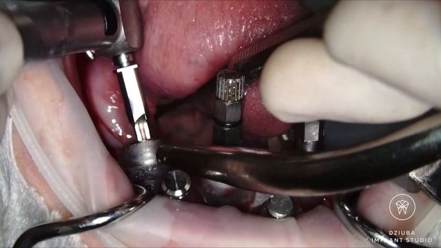 All On Four - Soft Tissue Management - Mguide Mis - Dziuba Implant Studio