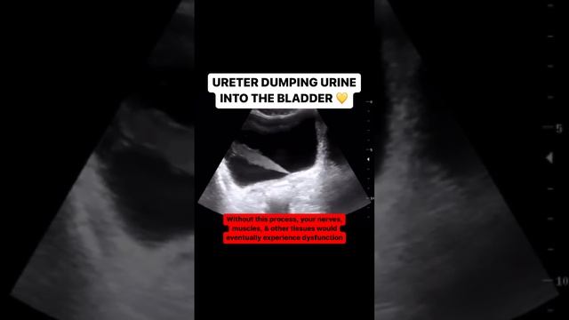 Ureter jetting urine into the bladder смотреть онлайн