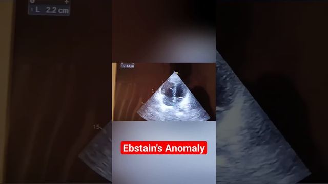 Ebstein's anomaly смотреть онлайн