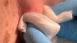 Опорожнение Атеромы