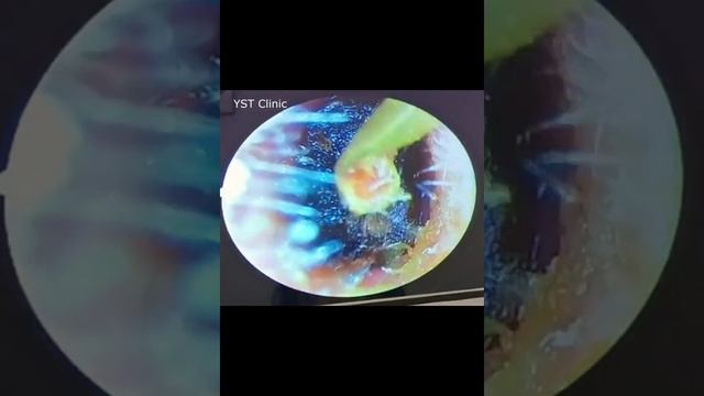 Suffering from Ear Blockage ,Ear Pain since last 3 month - Got relief after Procedure смотреть онлайн
