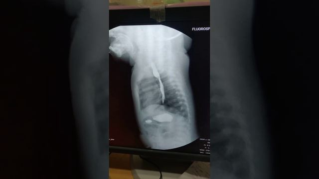 Esophageal Atresia With TEF Operated Elsewhere. Barium Swallow