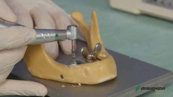 Установка имплантата Straumann BLT