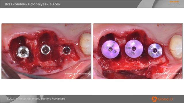 Негайна імплантація в лунки видалених зубів за одноетаповим протоколом