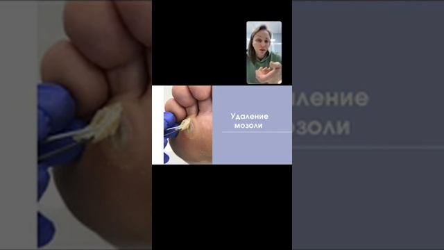 dostup podo marinashiglina Как деформация стопы влияет на образование мозолей 01 смотреть онлайн