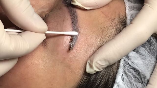 Tattoo Removal: Removing Old PMU Tail смотреть онлайн
