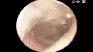Эндоскопия уха: нормальная эндоскопическая картина