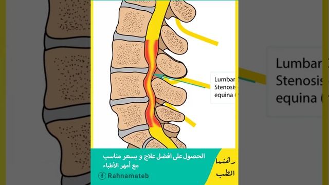 ضيق قناة النخاع смотреть онлайн