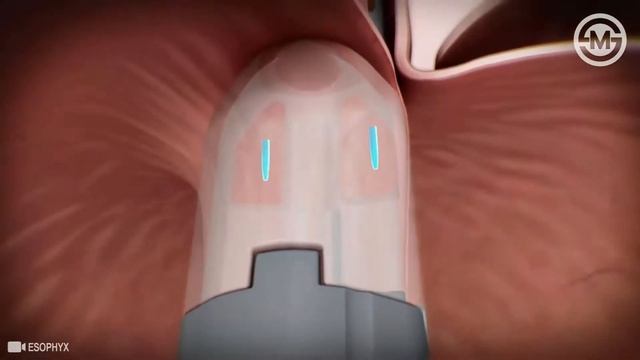 Endoscopic Treatment for Gastro-Esophageal Reflux Disease (GERD or known as Acid Reflux) смотреть онлайн