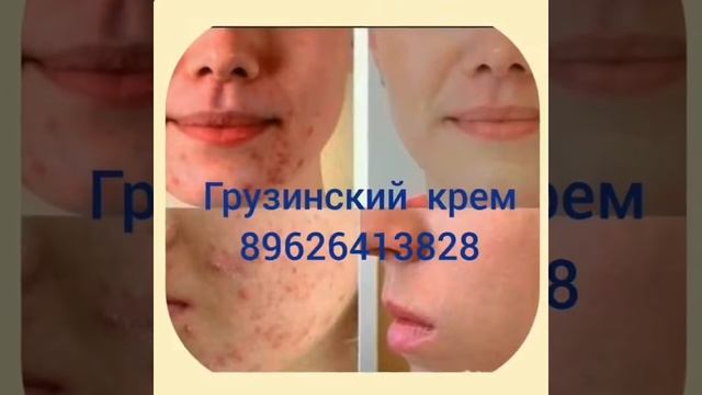 крем виши от пигментации на лице смотреть онлайн