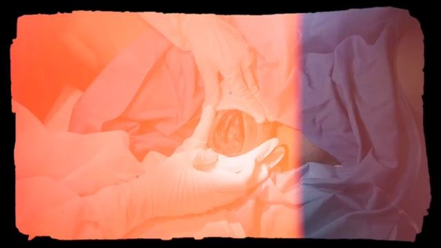 Teknik Penahanan Perineum (Proses Melahirkan Normal)