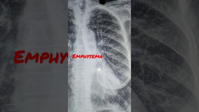Pulmonary emphysema смотреть онлайн