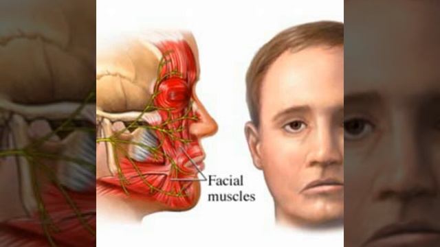 Lumpuh Badan Disebabkan Stroke