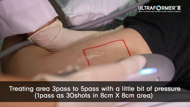 ULTRAFORMER III BODY TREATMENT FOR BODY CONTOURING EXCLUSIVELY BY GEOMEDICS PHARMA PVT LTD смотреть онлайн