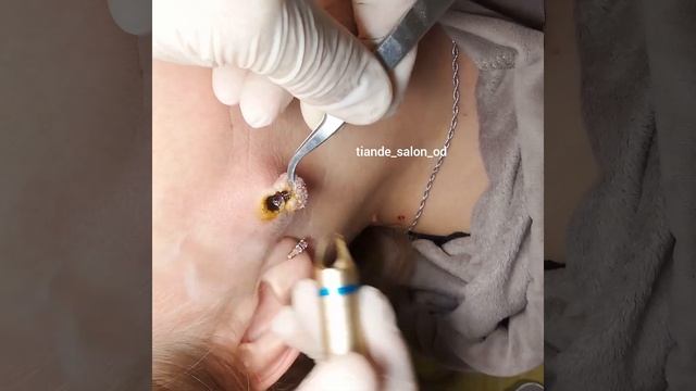 Удаление новообразования на лице лазерным методом смотреть онлайн