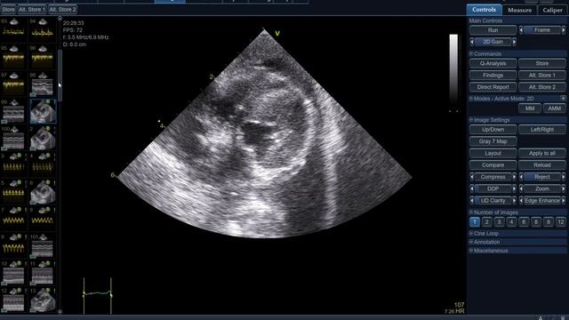 56334 TFAST, LUNG ULTRASOUND, PULMONARY EDEMA EFFUSION PH=7.5 ECHOPAC ANALYSIS, смотреть онлайн