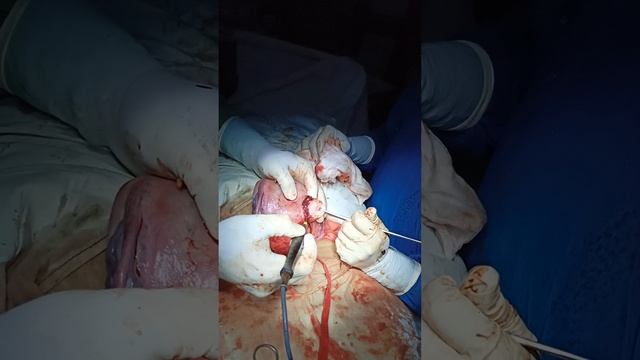 Myomectomy during Cesarean section, Fibroid смотреть онлайн
