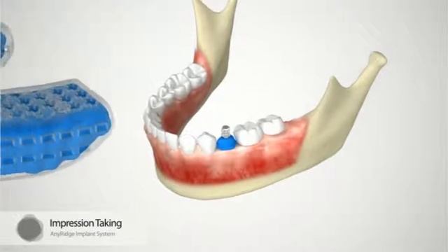 Анимированный обзор работы с имплантационной системой AnyRidge