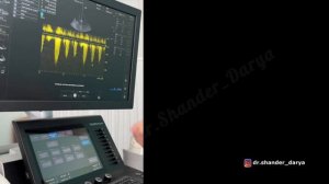 Эхокардиография. Разбор случая с АОРТАЛЬНЫМ СТЕНОЗОМ, низкой ФВ, ФП, ДИЛАТАЦИЕЙ всех полостей.