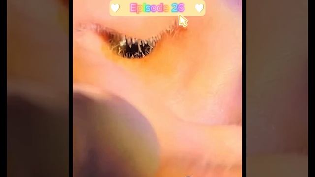 ASMR. Earwax Has Pus And Inflammation. #earwax #earwaxremoval #earwaxcleaning #asmr #viral #relaxin