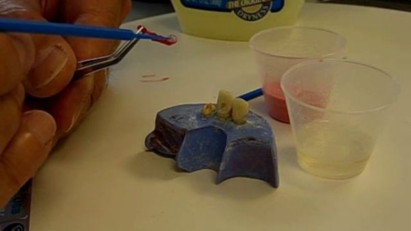 Cast Post Core Using GC Pattern Resin - Dr. Antonelli