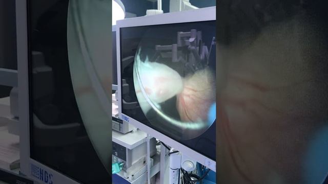 Papiloma invertido vesical смотреть онлайн