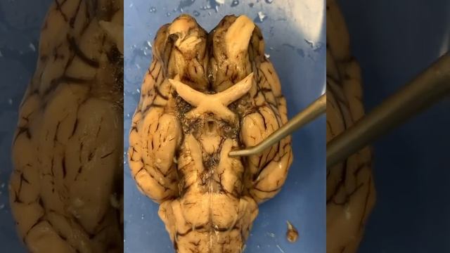 Brain Dissection - Cranial Nerves смотреть онлайн
