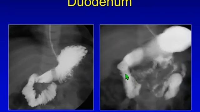 Basic Imaging Anatomy and Major Variants of Hollow Viscera and Peritoneium смотреть онлайн