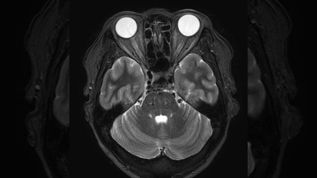 HN C8 Optic Neuritis (A)